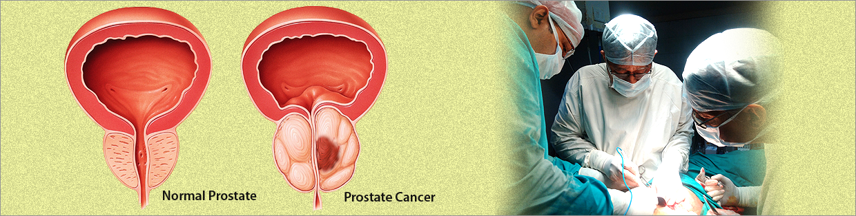 Can interstitial cystitis and prostate hypertrophy occure simultaneously